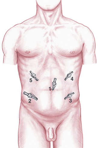 Puntos del abdomen por donde realizan cirugía de laparoscopía